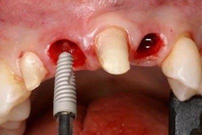 Отдаленные результаты имплантации в эстетической зоне