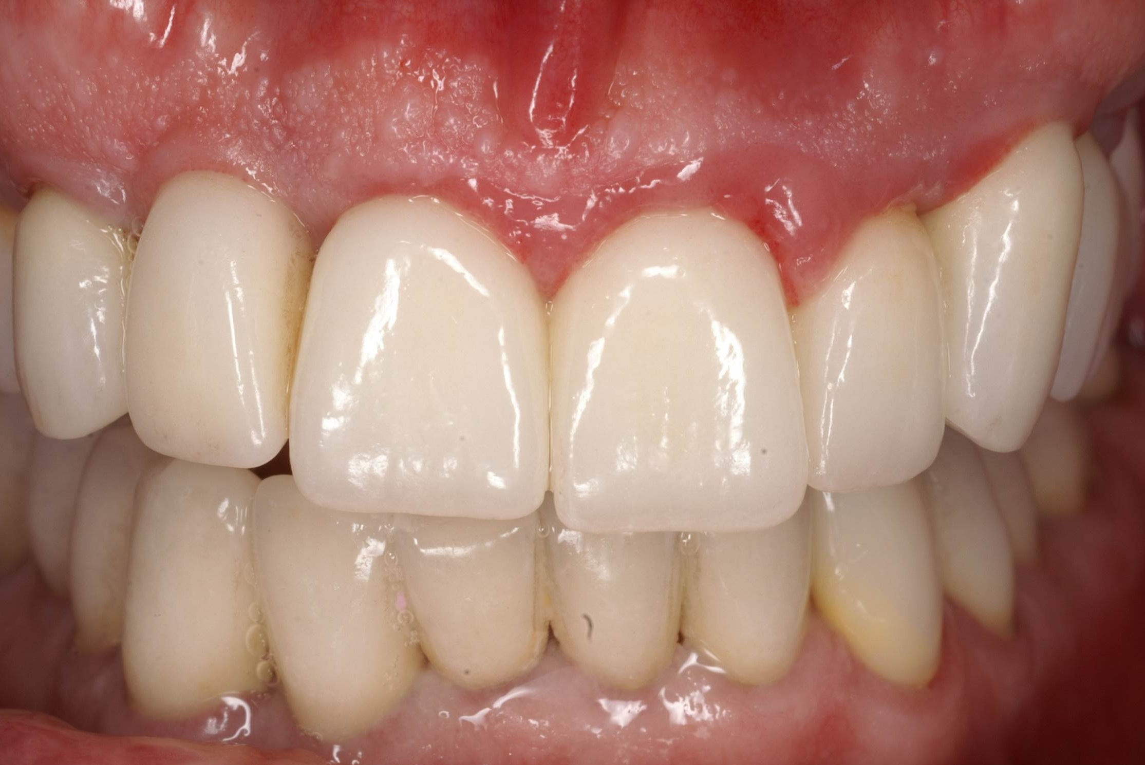 Одномоментная имплантация Ritter в сочетании с немедленной нагрузкой