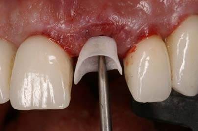 Двойной менеджмент мягких тканей