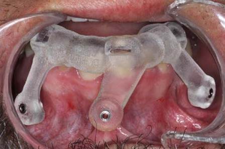 Все на 6. Навигационная хирургия Ritter