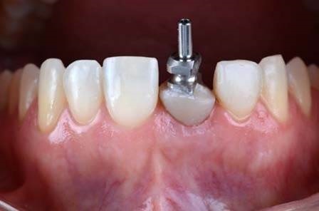 Одномоментная имплантация с максимальным сохранением гребня