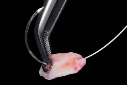 Имплантация Ritter в сочетании с пластикой туннельным способом